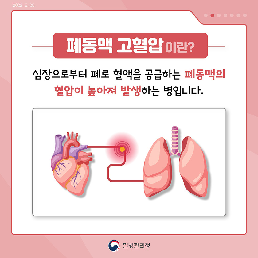 폐동맥 고혈압이란? 심장으로부터 폐로 혈액을 공급하는 폐동맥의 혈압이 높아져 발생하는 병입니다.